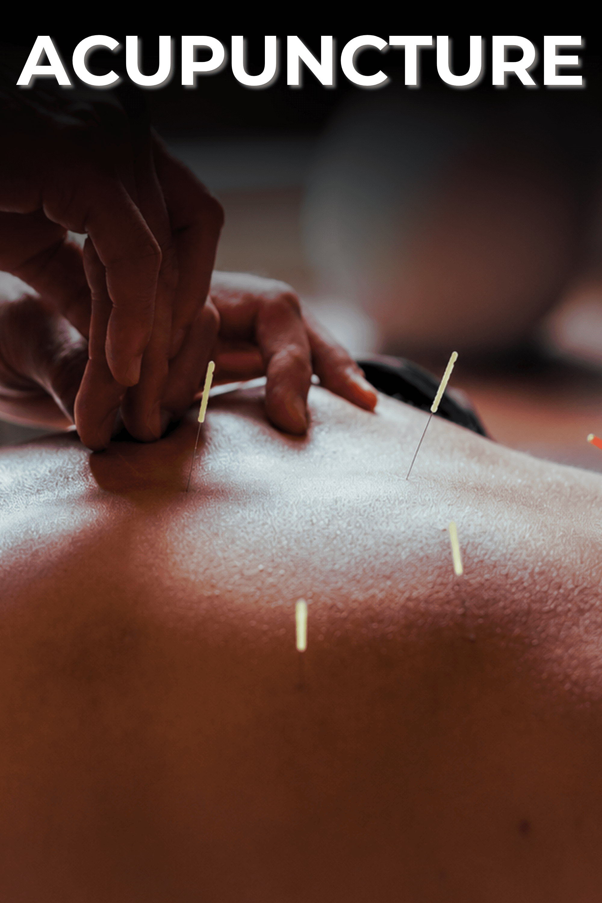 Acupuncture